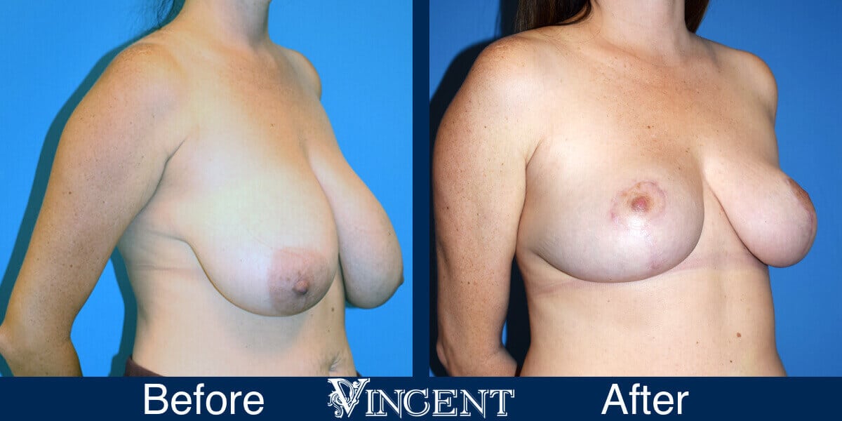 Breast Lift Before and After Photos 1