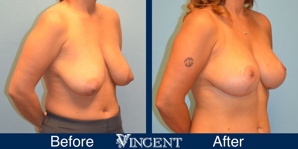 Breast Lift Before and After Photos 2