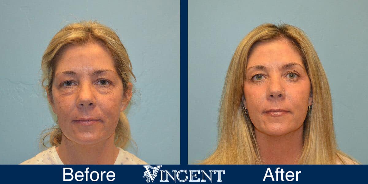 CO2 Laser Resurfacing Before and After Photos 1