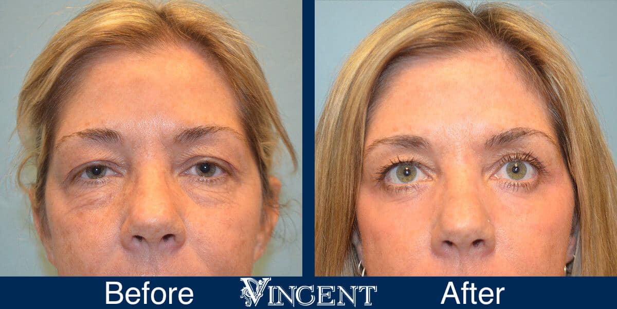 CO2 Laser Resurfacing Before and After Photos 2