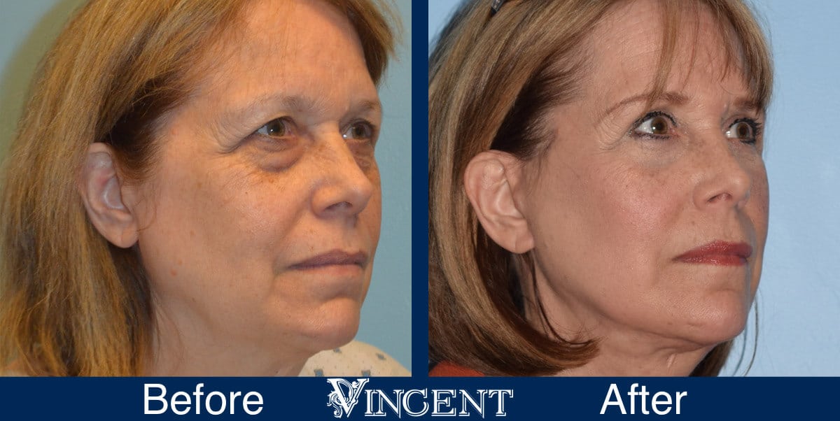 Facelift Before and After Photos 