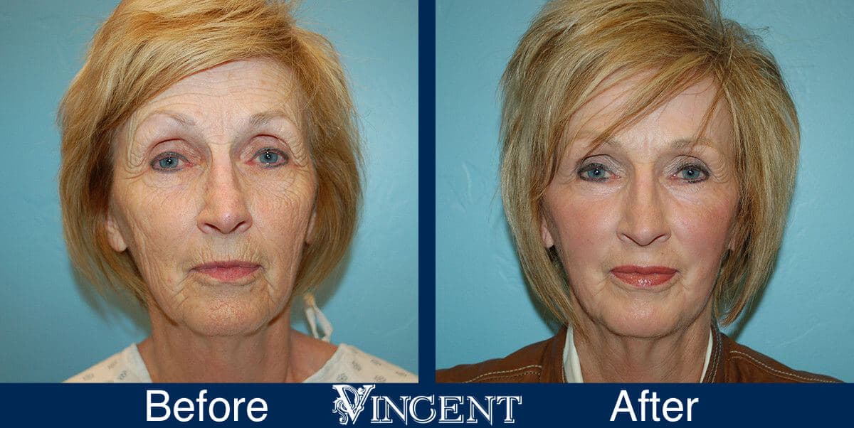 Fat Transfer Face Lift offers an alternative approach for patients who want a more natural cosmetic procedure. Fat transfer surgery is performed on an out-patient basis with IV sedation and usually takes about one hour. Fat Transfer Face Lift Before and After Photos 1