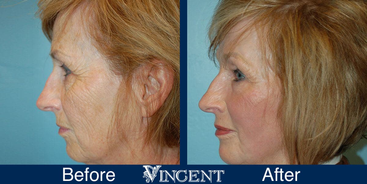 Fat Transfer Face Lift Before and After Photos 2