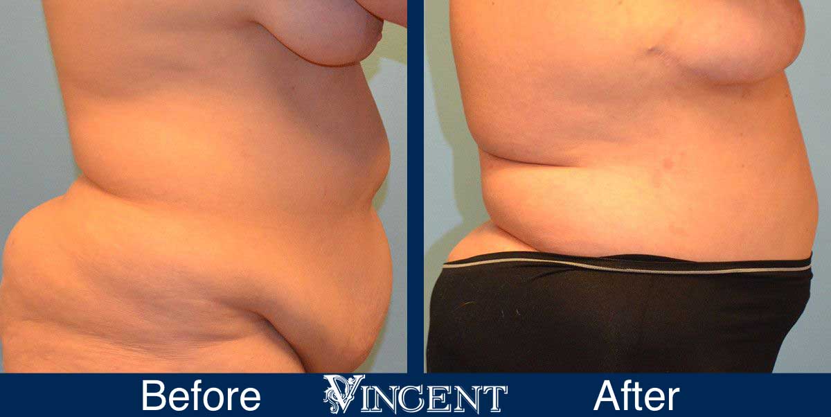 Vincent Surgical Arts  Liposuction Procedure in Cottonwood Heights