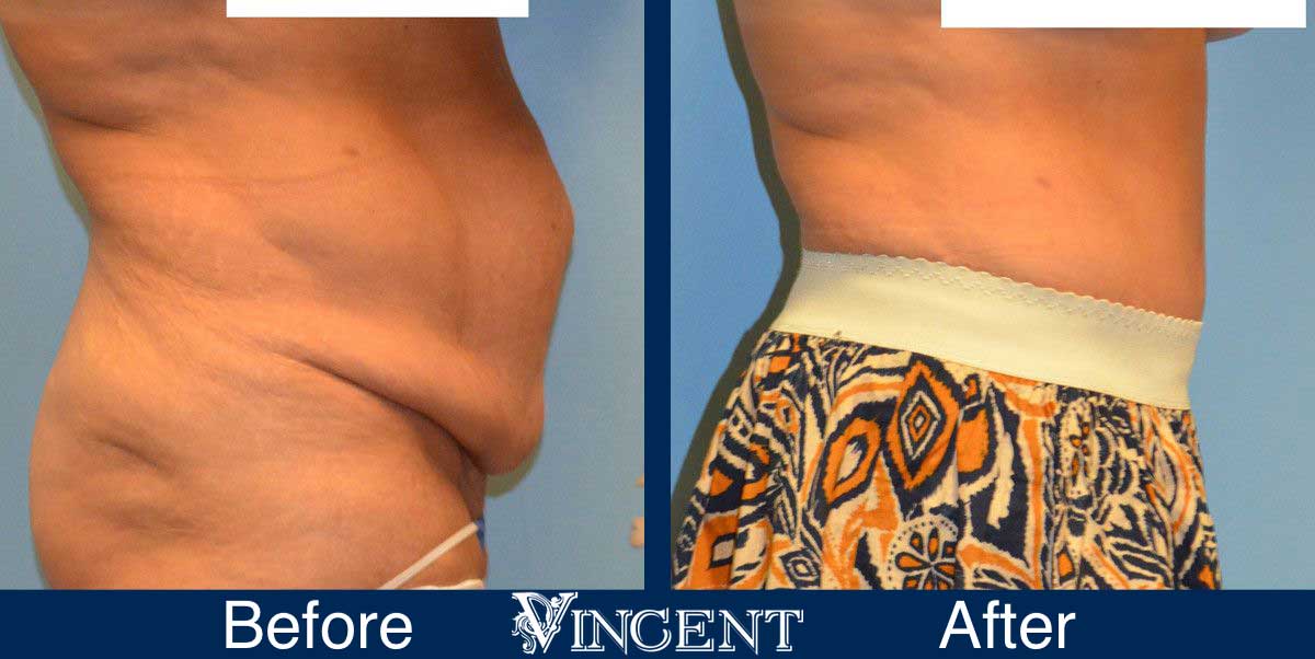 Liposuction Cosmetic Surgery Before and After 2