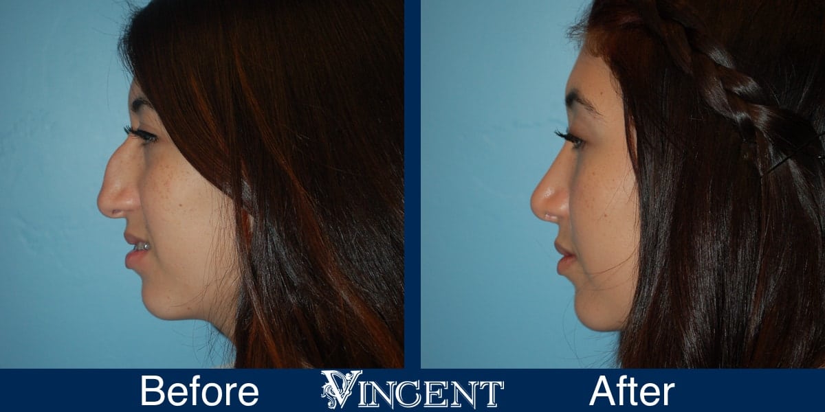 Nose Job Before and After Photos