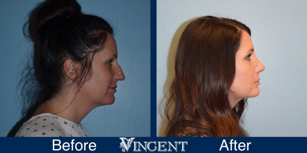 Rhinoplasty Nose Job Utah Vincent Surgical Arts &amp; Medspa