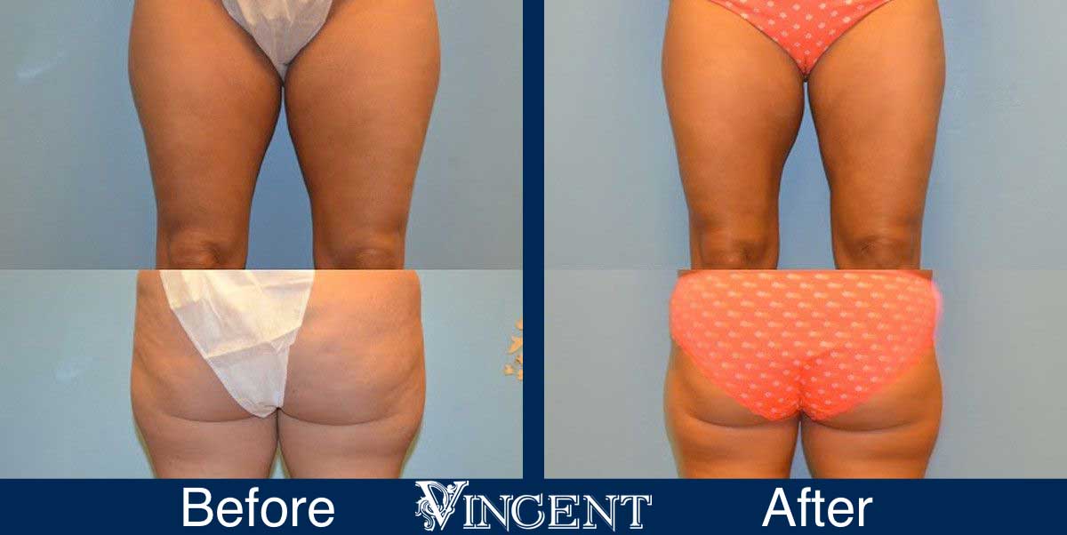 Thigh Lift Surgery Before and After Photos