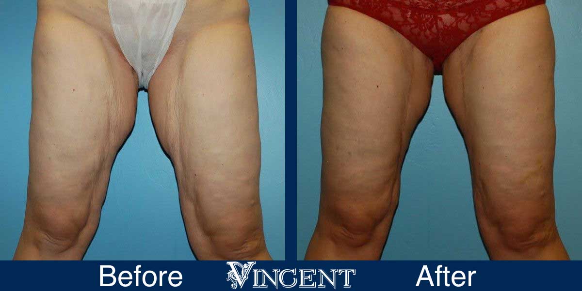 Thigh Lift London, Thigh Reduction Surgery UK