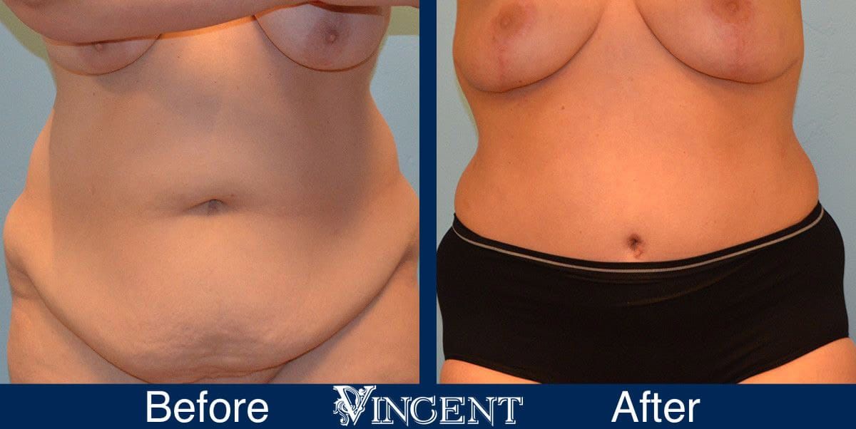 Tummy Tuck Before and After Photos 2