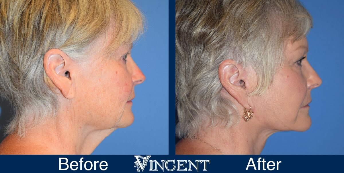 Vincent Surgical Arts  Belt Lipectomy in Cottonwood Heights