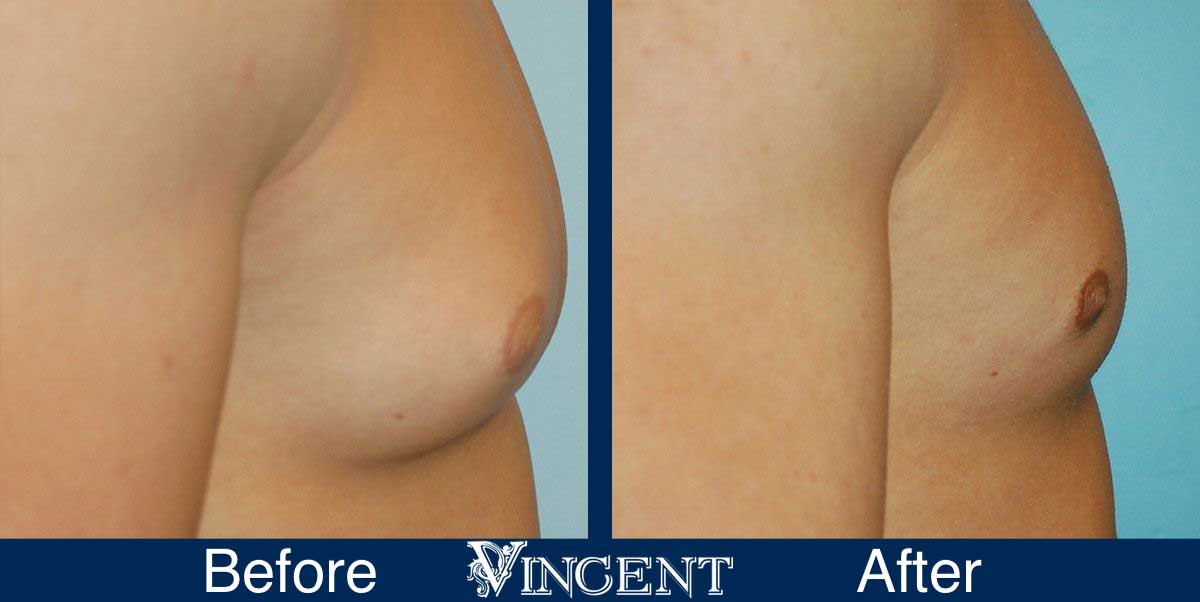 Vincent Surgical Arts: Male Breast Reduction Surgery Utah Vincent Surgical Arts: Male Breast Reduction Surgery Utah
