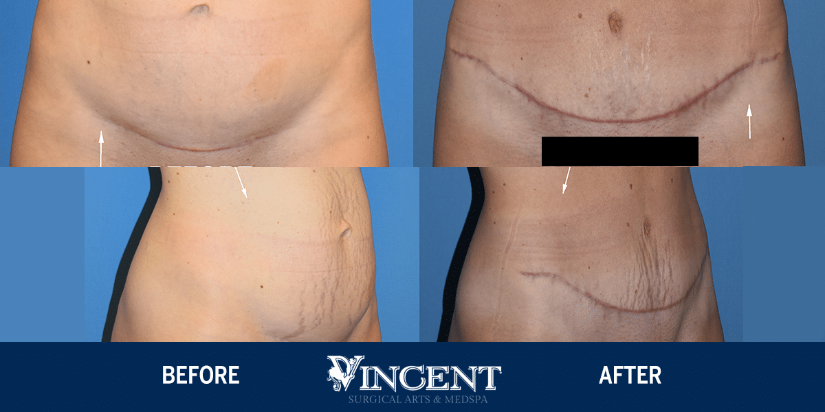 Tummy Tuck Before & After Gallery