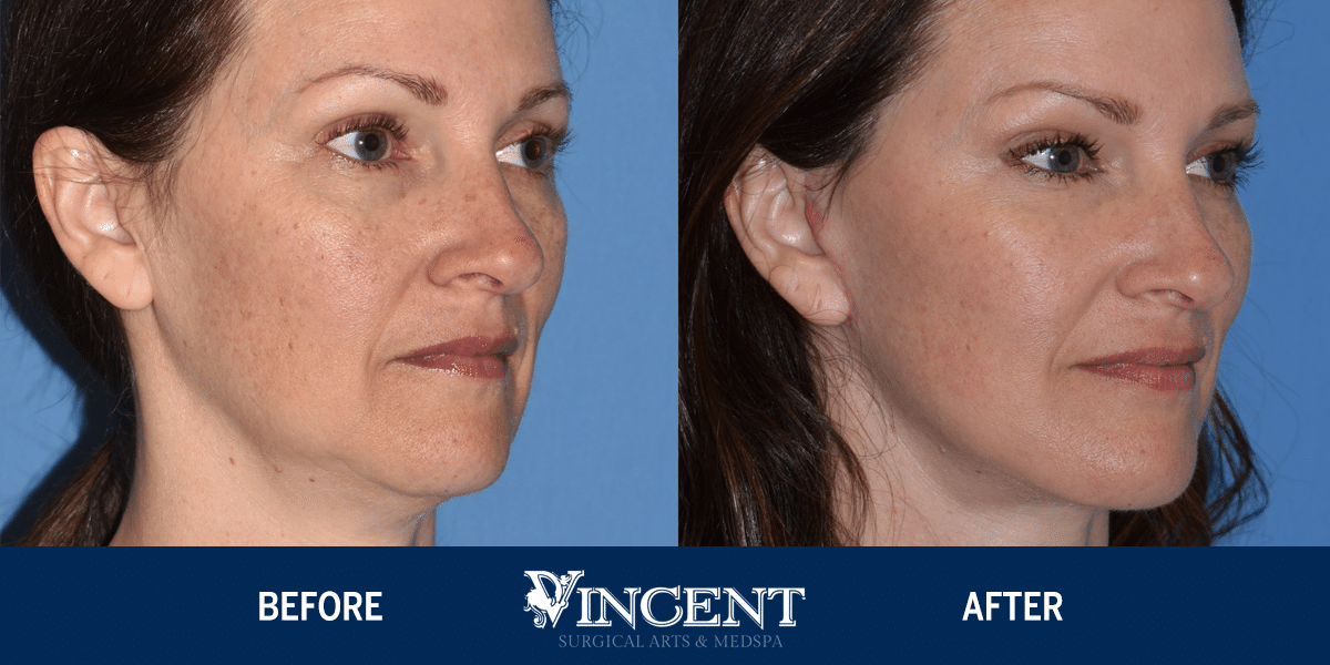 Facelift Angle Before and After Photos