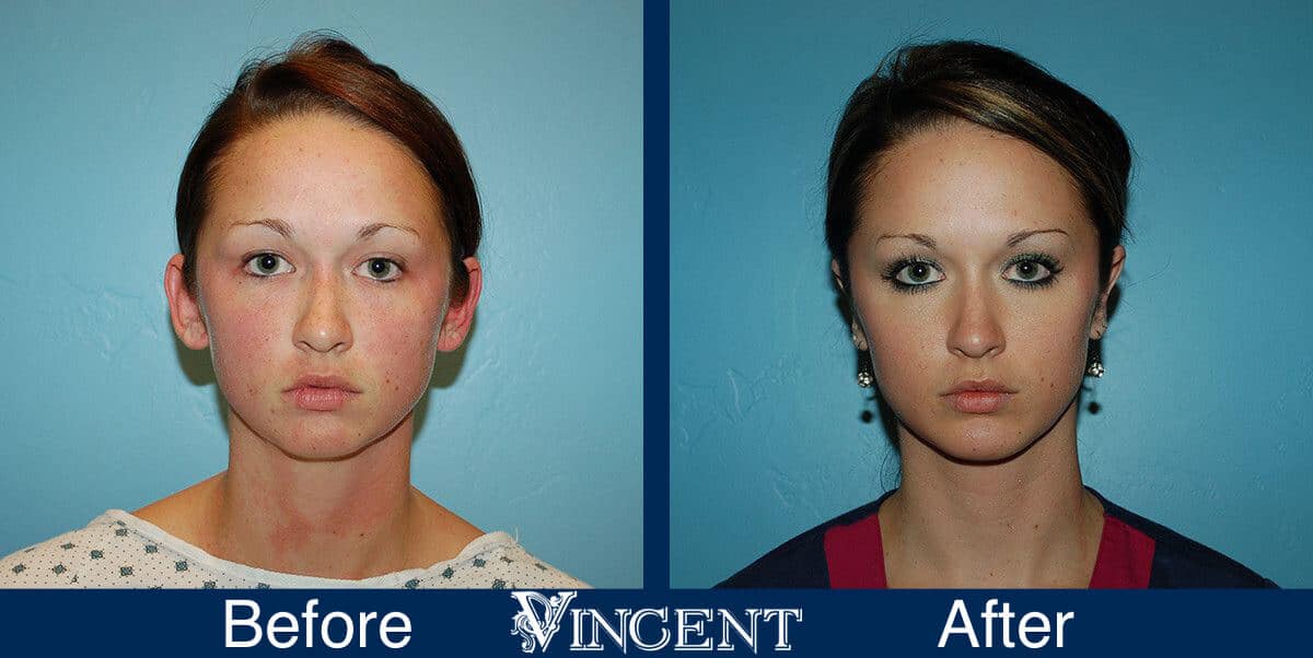 Otoplasty Utah Before and After Photos Front
