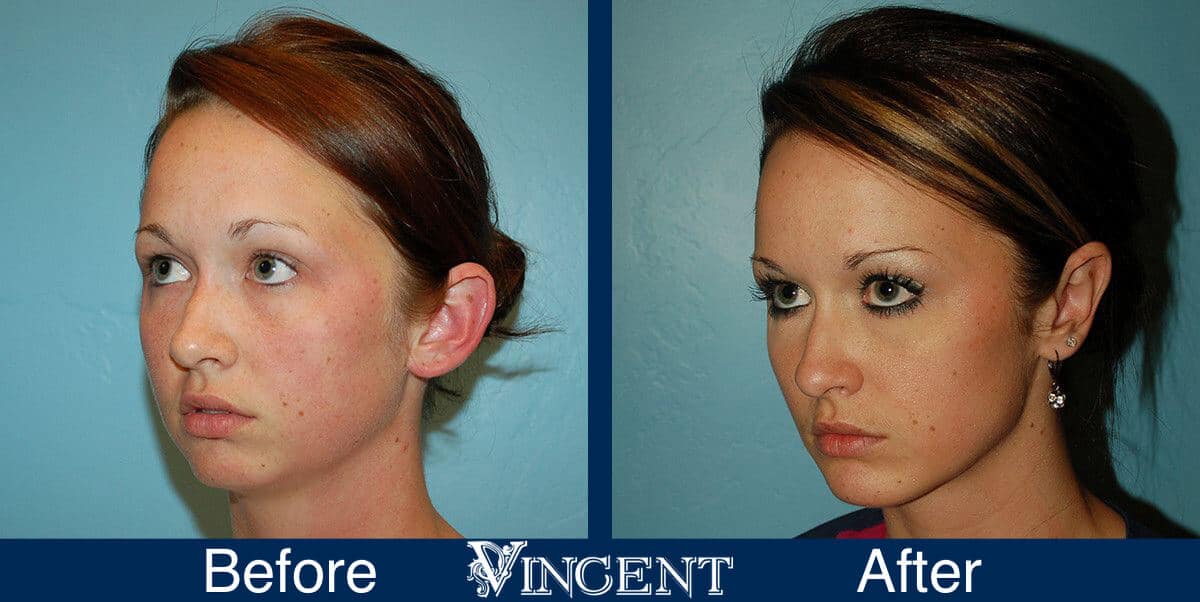 Otoplasty Utah Before and After Photos Side