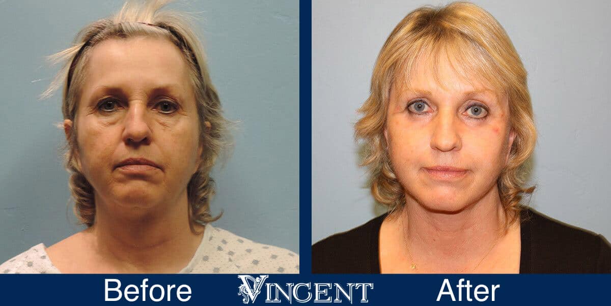 Utah Eyelid Surgery Before and After Photo 1