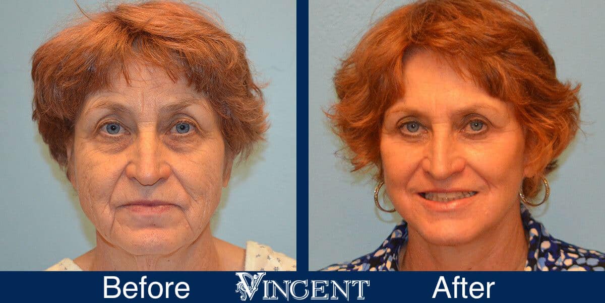 Utah Eyelid Surgery Before and After Photo 2