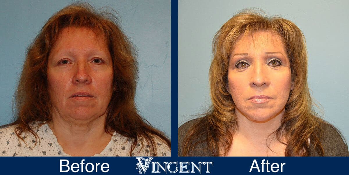Utah Eyelid Surgery Before and After Photo 3