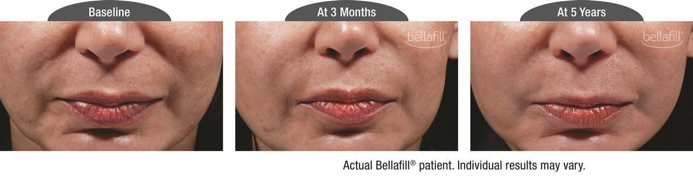 Utah Bellafill Injections Progress Photo