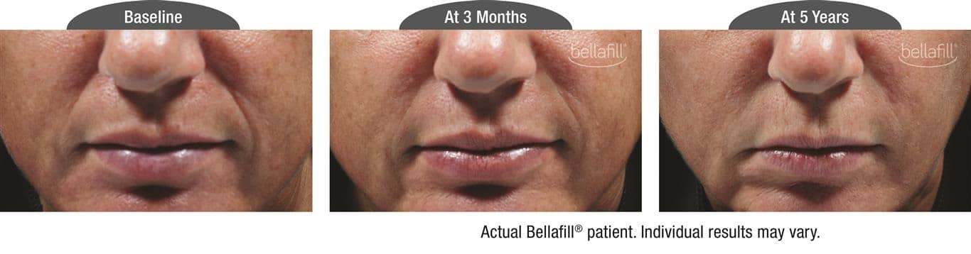 Utah Bellafill Injections Progress Photo