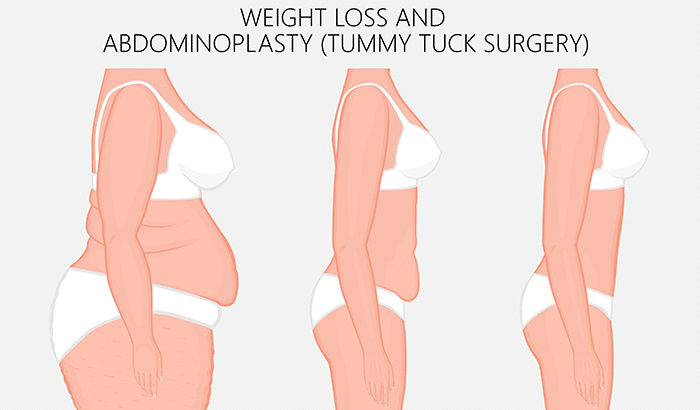What Makes Someone a Good Candidate for a Tummy Tuck?