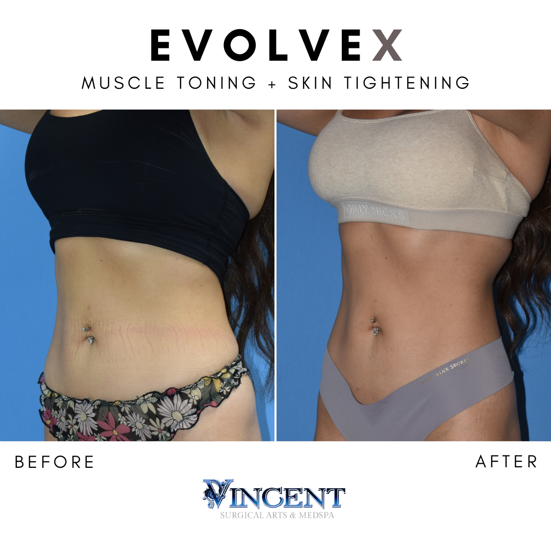 Muscle Toning - Evexia Medspa