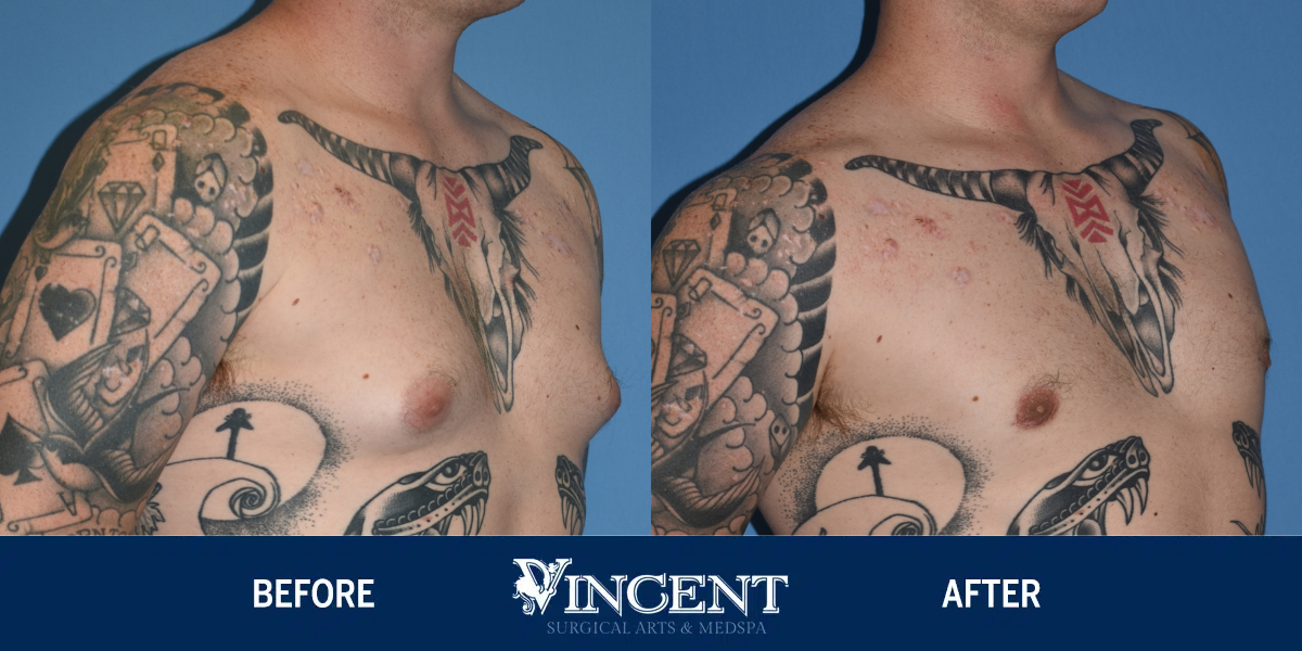 Vincent Surgical Arts: Male Breast Reduction Surgery Utah