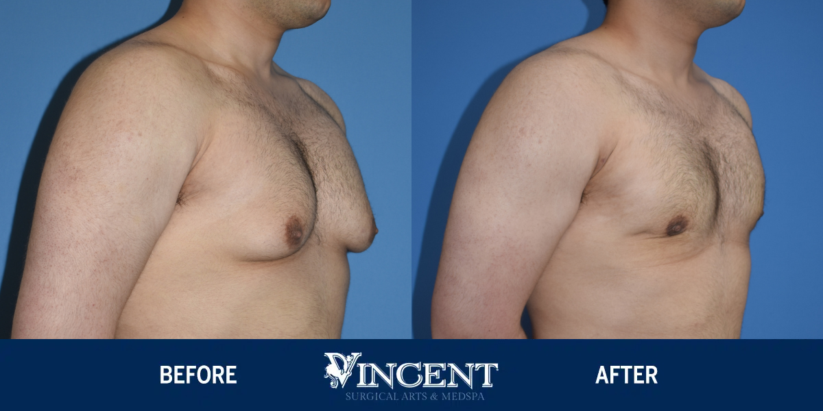 Vincent Surgical Arts  Belt Lipectomy in Cottonwood Heights