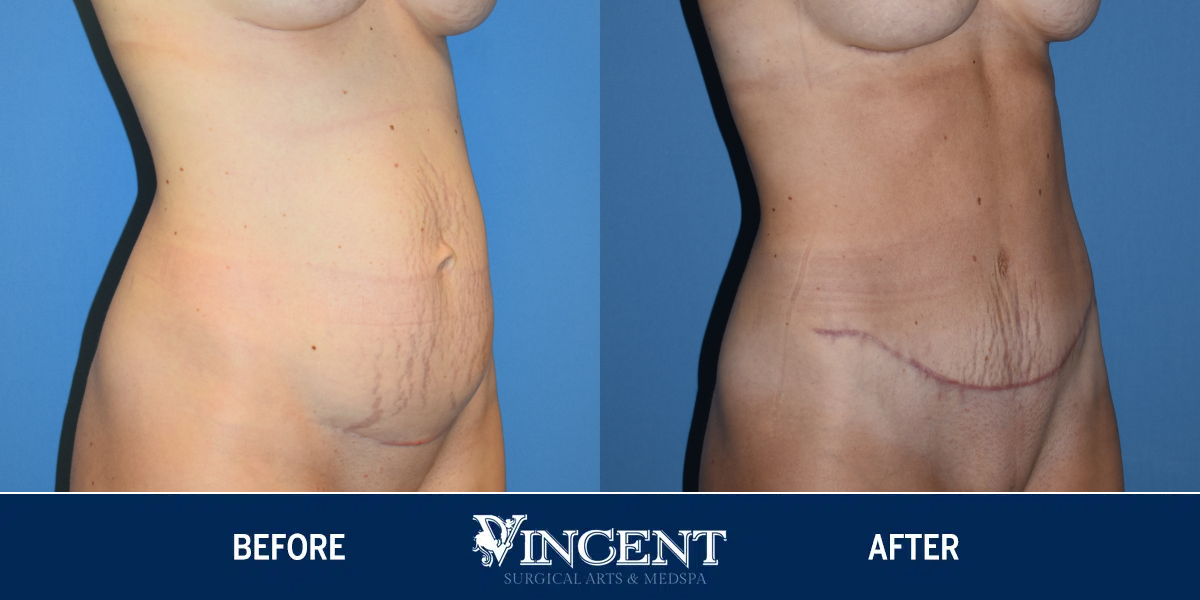 Vincent Surgical Arts  Belt Lipectomy in Cottonwood Heights