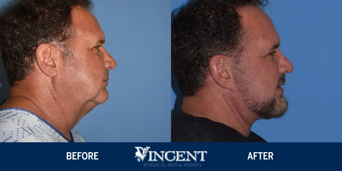 MRN-108104-Facelift-and-Buccal-Pad-Fat-Removal