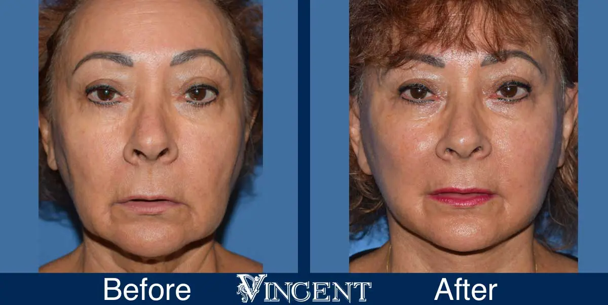 facelift-before-and-after-utah-swiftlift-914874-front