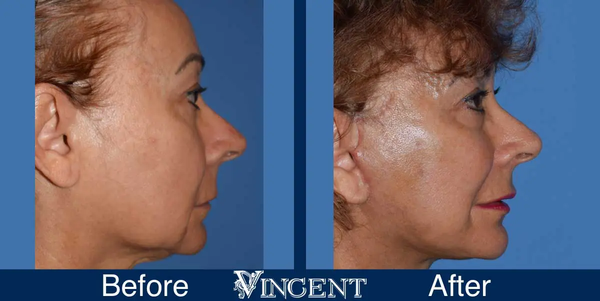 facelift-before-and-after-utah-swiftlift-914874-right-side