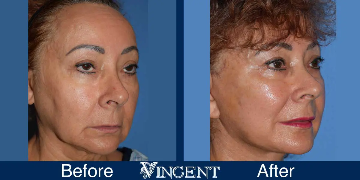 facelift-before-and-after-utah-swiftlift-914874-right