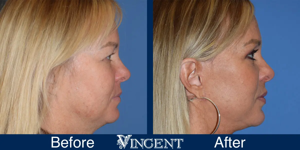 swift-lift-before-and-after-facelift-side-1-1