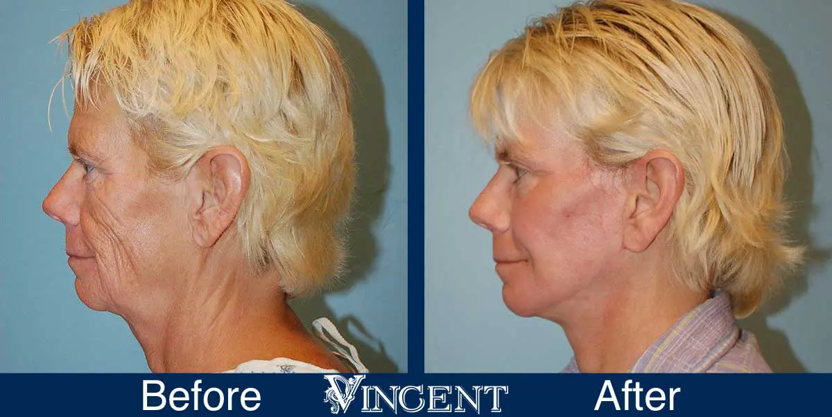 1029_SwiftLift_CO2_full_face_fat_grafting_Drake_Vincent_Facelift_Utah_sideview