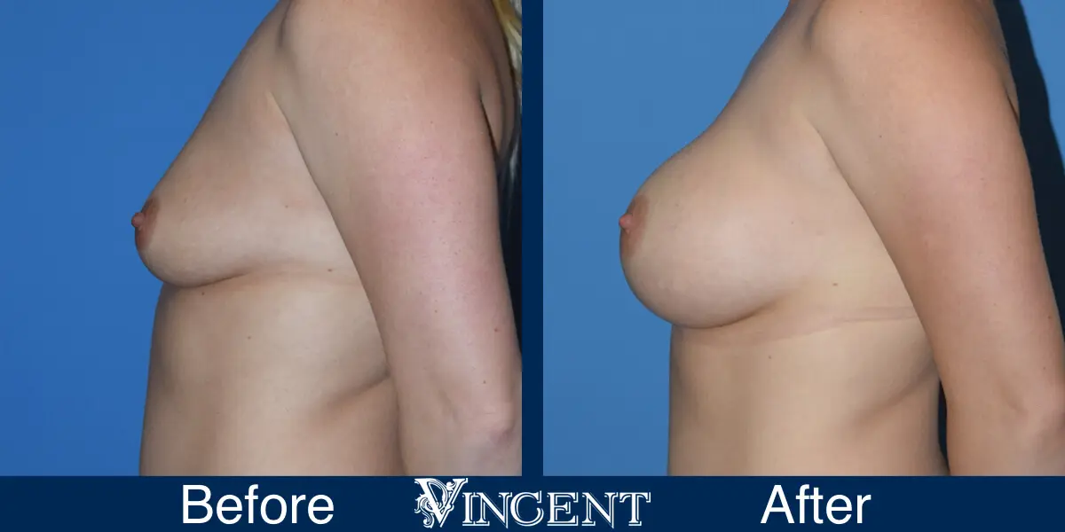 510cc-SALINE-Subpec-Smooth-Moderate-Plus-1