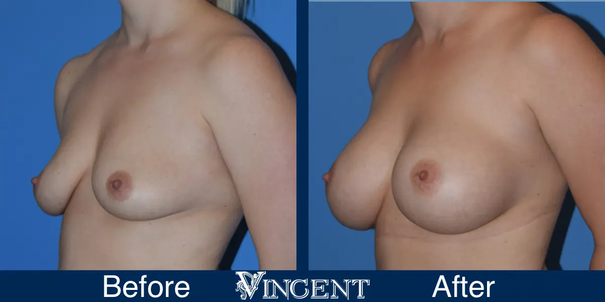 510cc-SALINE-Subpec-Smooth-Moderate-Plus-3