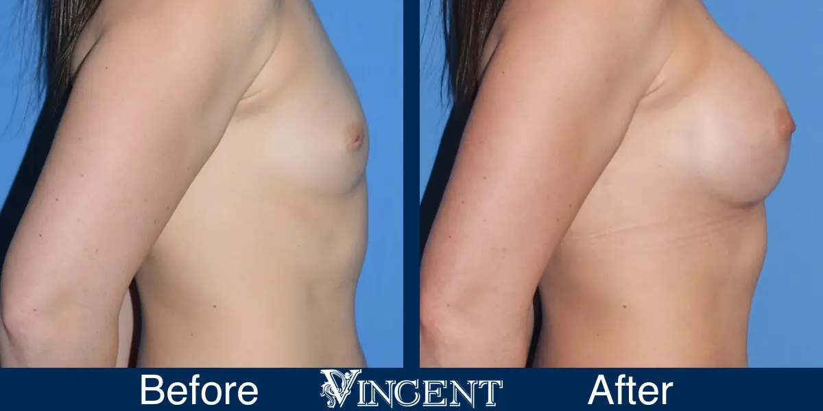 BBA-350cc-Subpec-Smooth-Moderate-Plus-Profile-w_-Inverted-Nipple-1