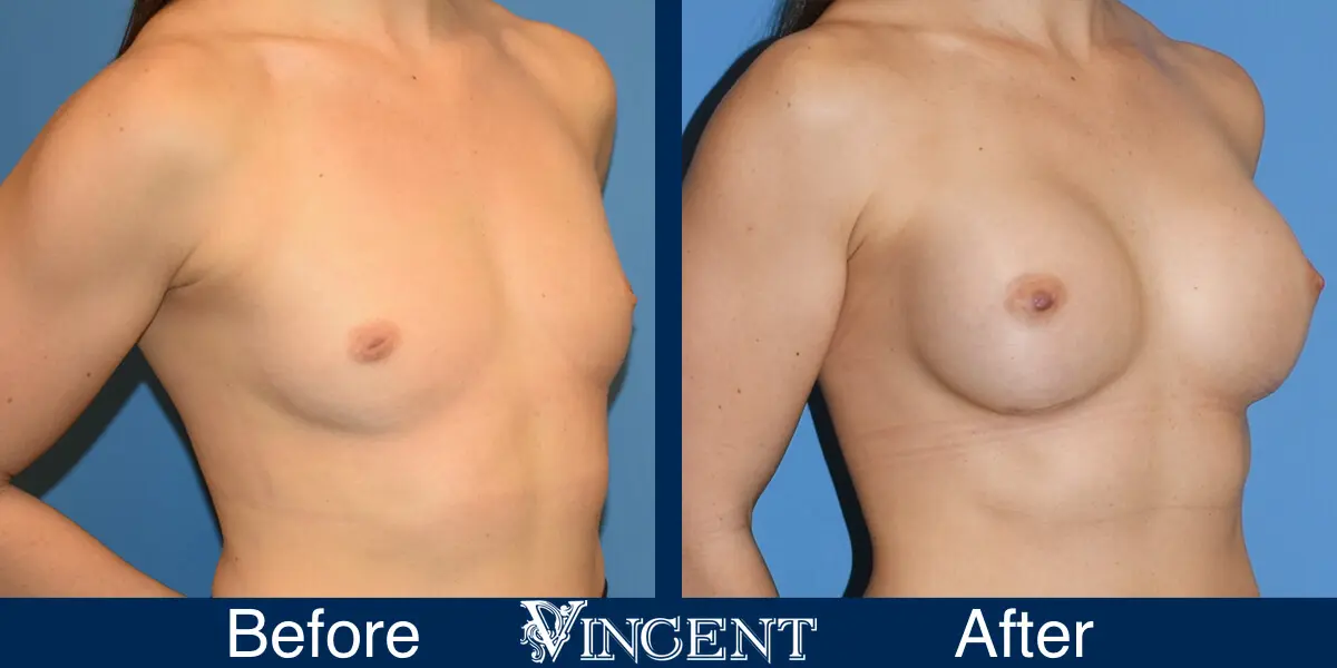 BBA-350cc-Subpec-Smooth-Moderate-Plus-Profile-w_-Inverted-Nipple-2