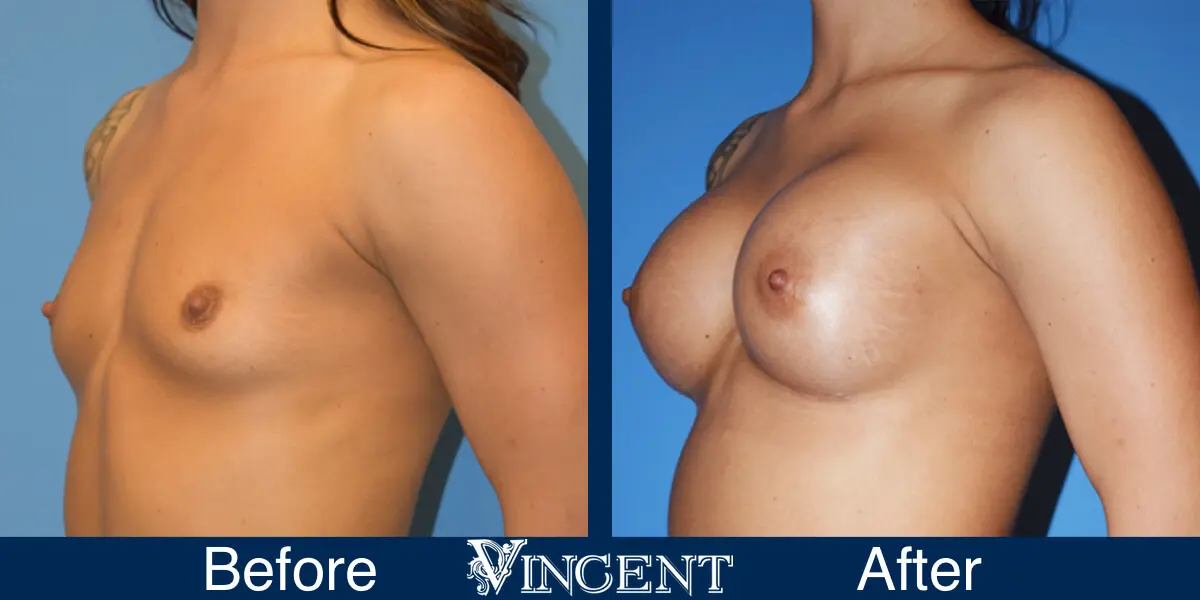 BBA-400cc-High-Profile-Subpec-Silicone-2