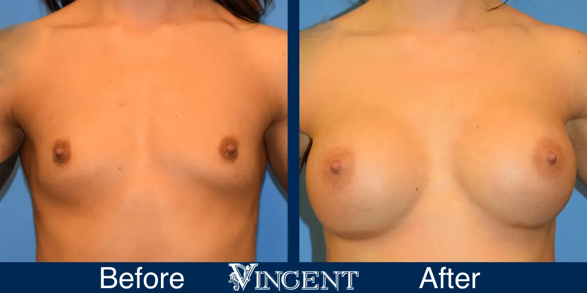 BBA-400cc-High-Profile-Subpec-Silicone-3