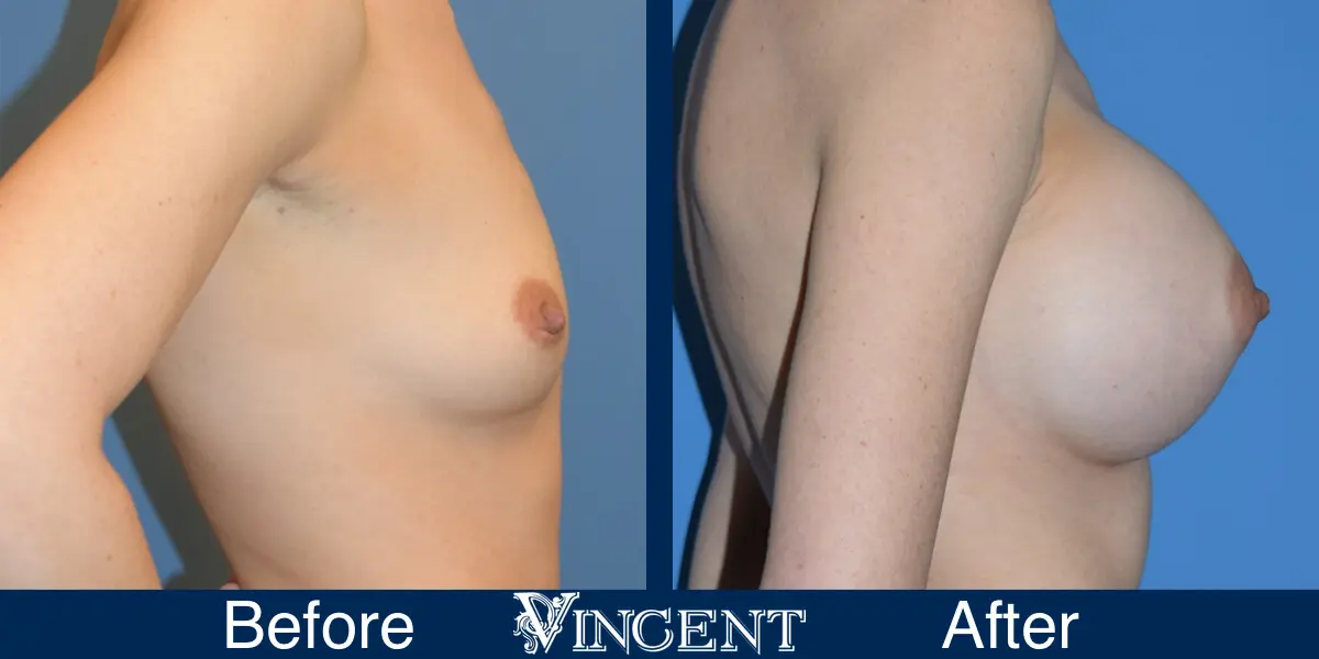 BBA-750cc-High-profile-Subpec-Silicone-1