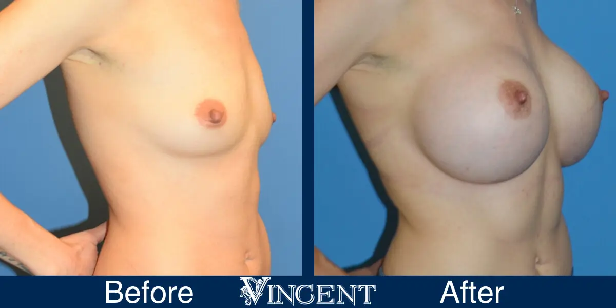 BBA-750cc-High-profile-Subpec-Silicone-3