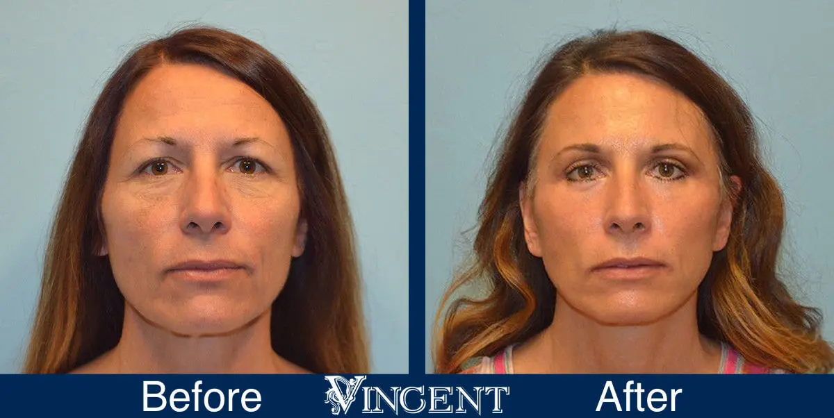 Blepharoplasty-before-and-after-utah-2602-Front