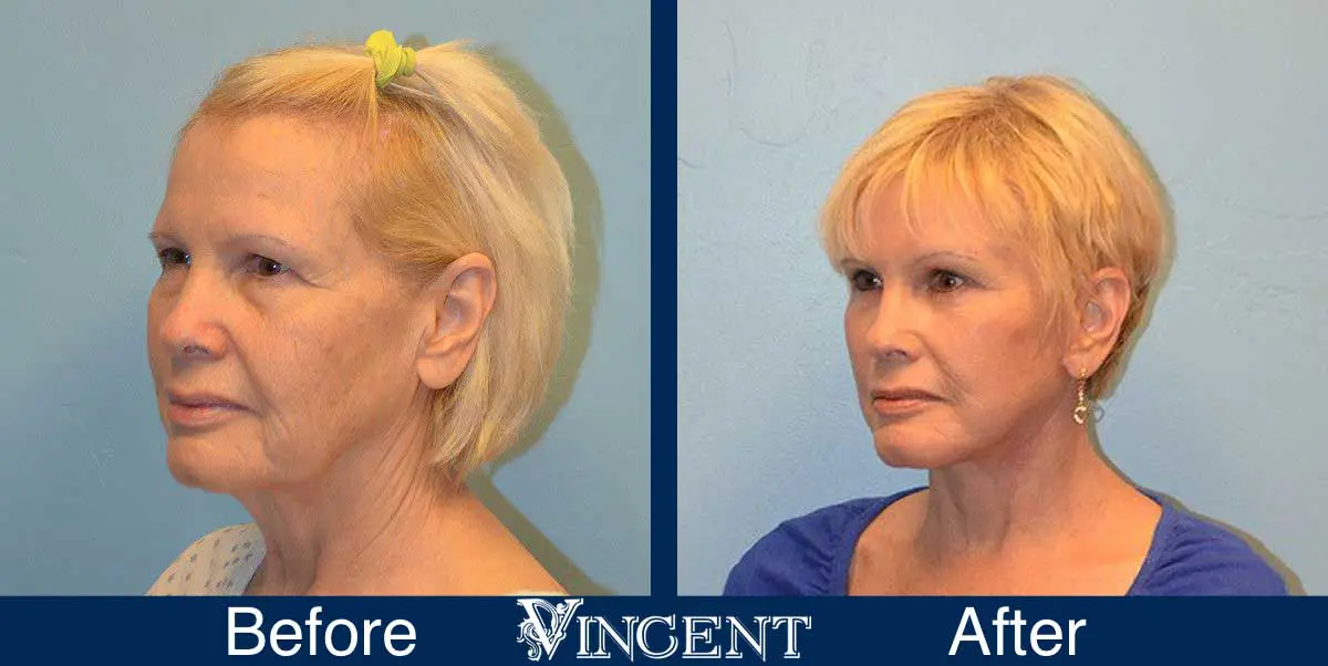 Blepharoplasty-before-and-after-utah-2603-Front-left