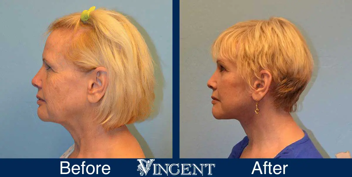 Blepharoplasty-before-and-after-utah-2603-left