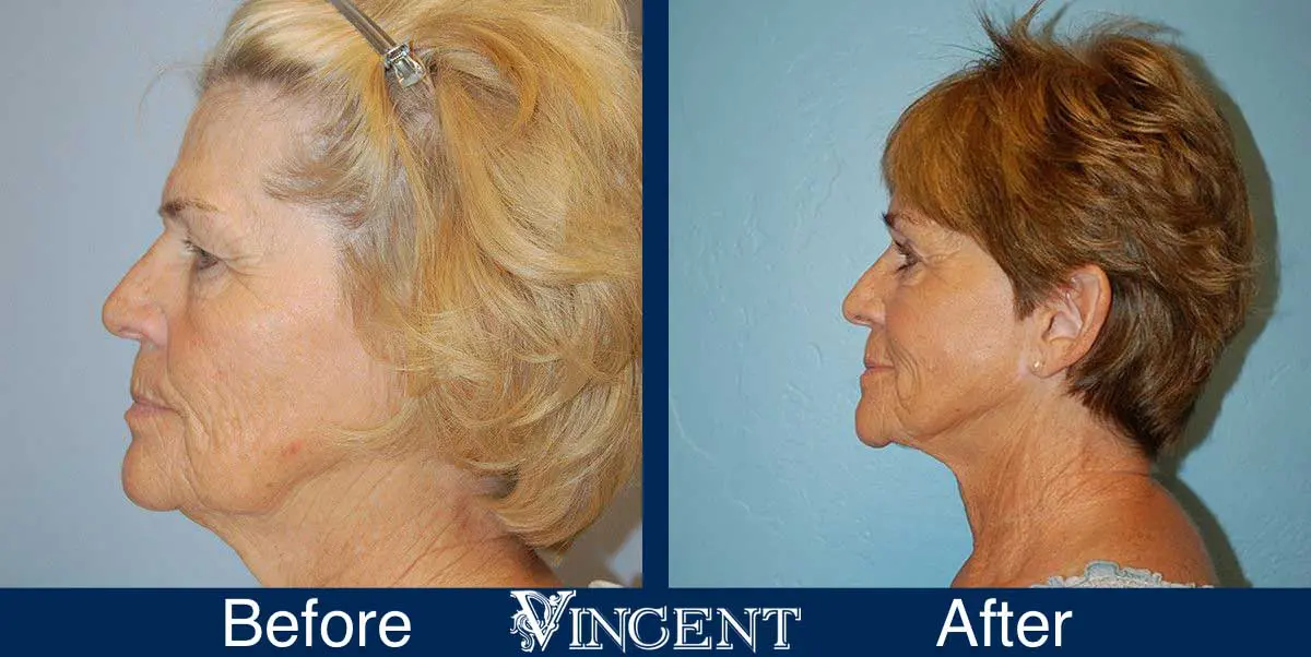 Blepharoplasty-before-and-after-utah-2604-left