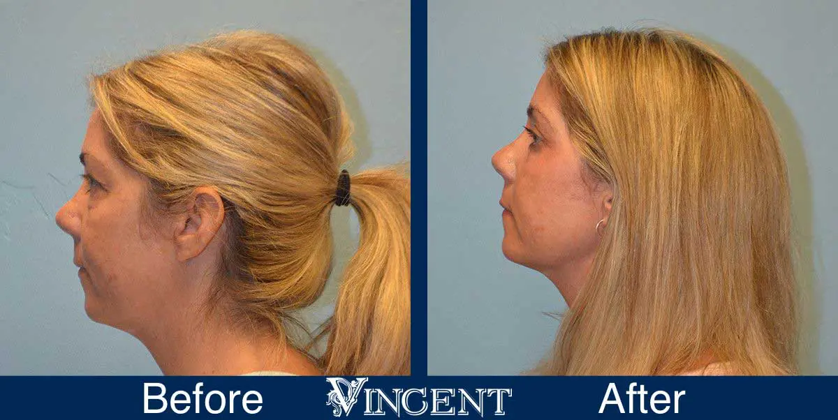 Blepharoplasty-before-and-after-utah-2605_Co2_leftside_1