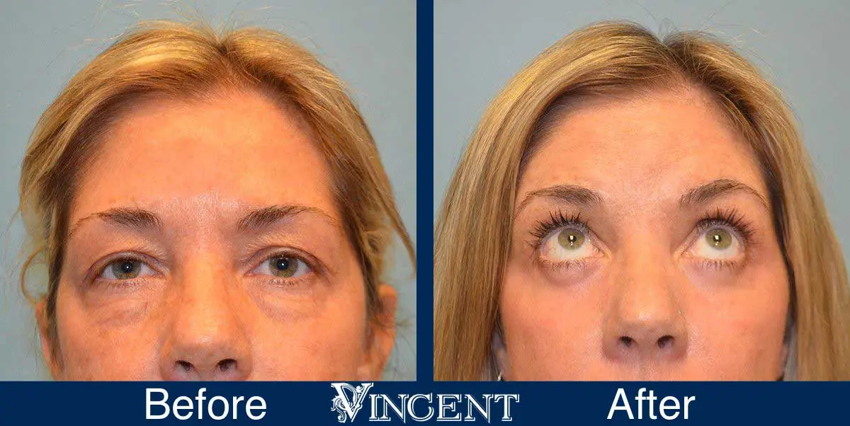 Blepharoplasty-before-and-after-utah-2605_Co2_lookup